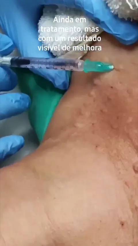 Frame real de uma aplicação na região do pescoço, com mãos enluvadas e seringa.