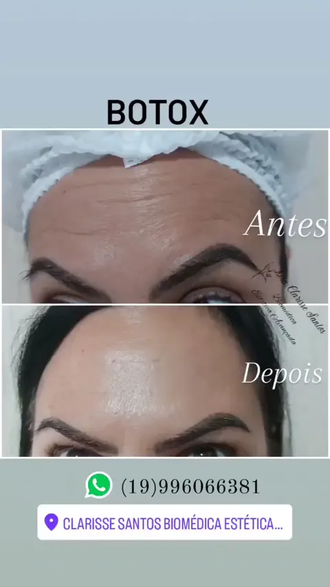 Frame real de vídeo com comparativo facial e identificação Botox no material original.